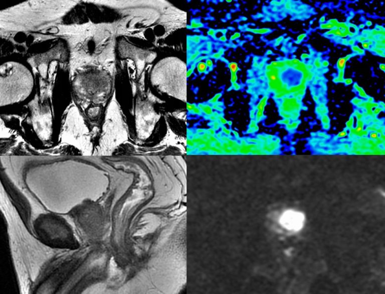 IRM de la Prostate - La Radiologie